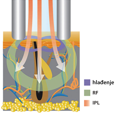 eLite Ana SHR IPL+RF