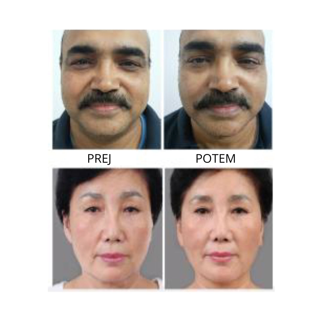 Mini hifu naprava 6v1