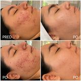 Plasma ART za njego lica