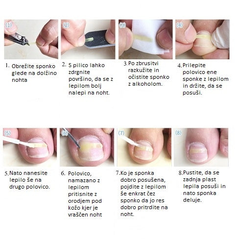 Sponke za vraščene nohte 10/1