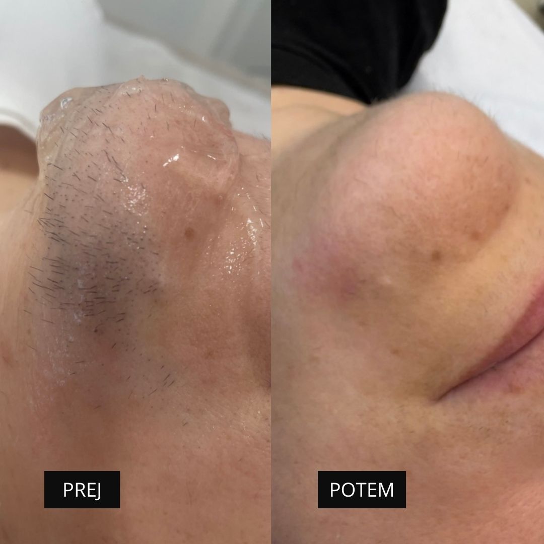 Diodni laser TrisCAM