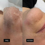 Diodni laser TrisCAM III